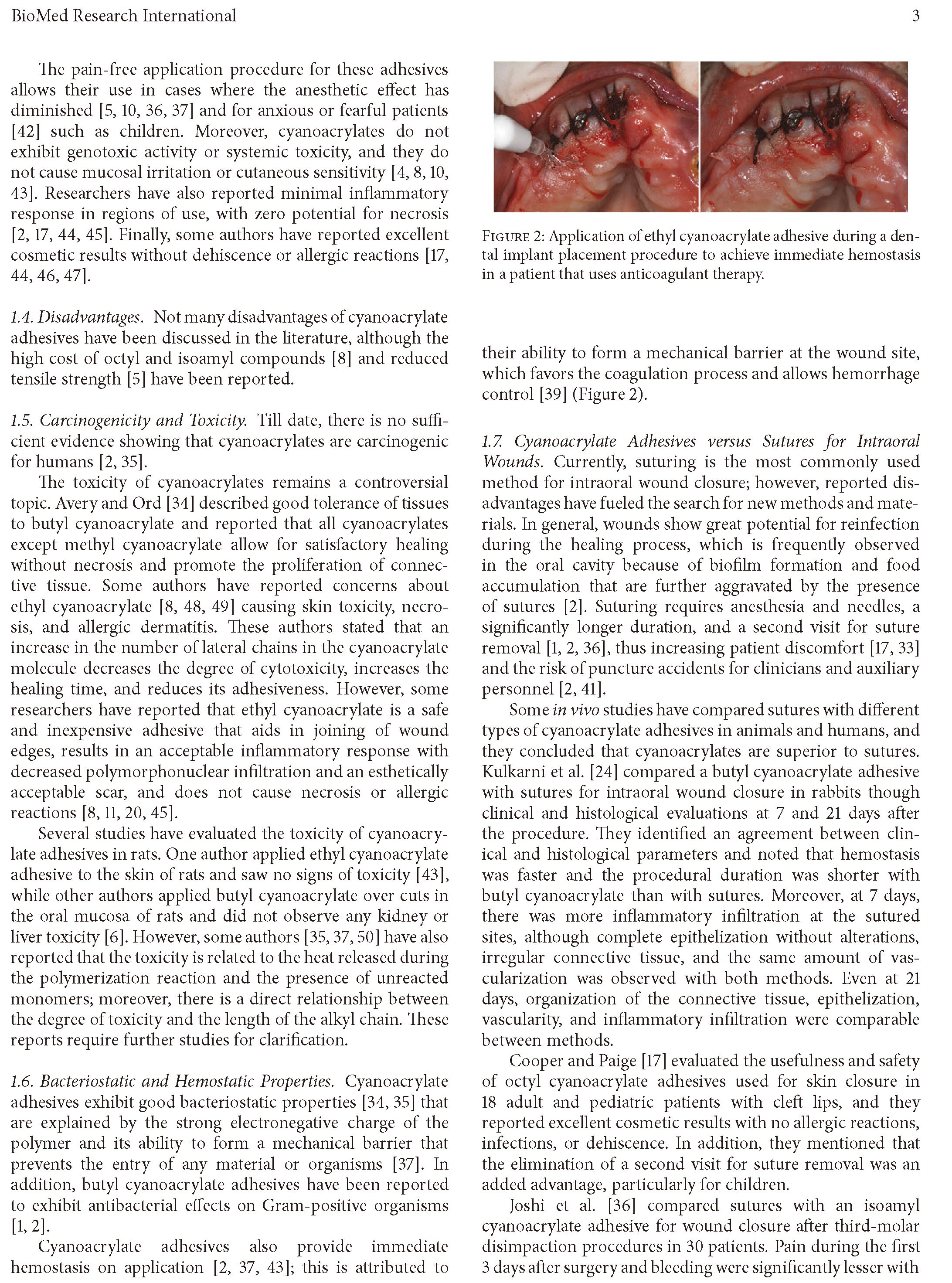 英文版-氰基丙烯酸酯粘合剂的口腔应用：文献综述-3.jpg